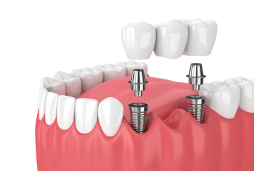 Dental Implants